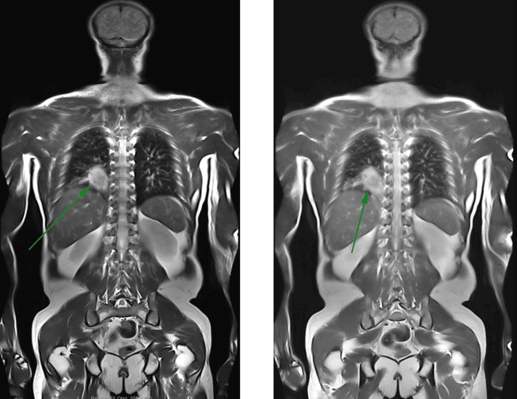 
Chụp MRI toàn thân giúp phát hiện nhiều bệnh lý
