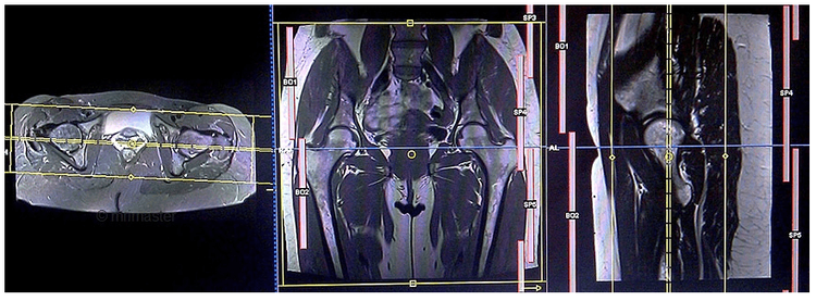 
Chụp MRI cho phép quan sát được khớp háng trong không gian 3 chiều
