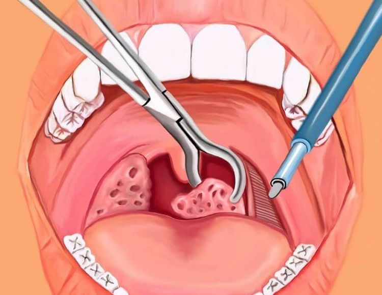 
Cắt amidan bằng laser
