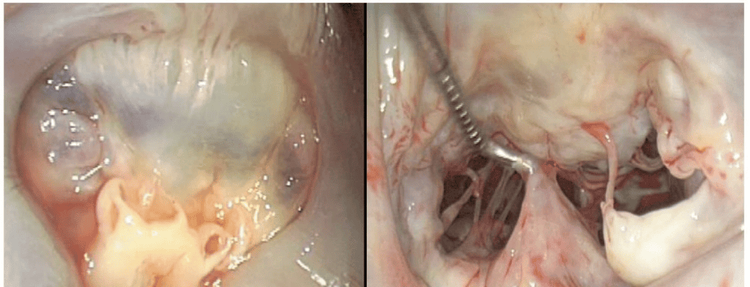 
Hình ảnh thiếu xơ chun van 2 lá (fibroelastic deficiency)
