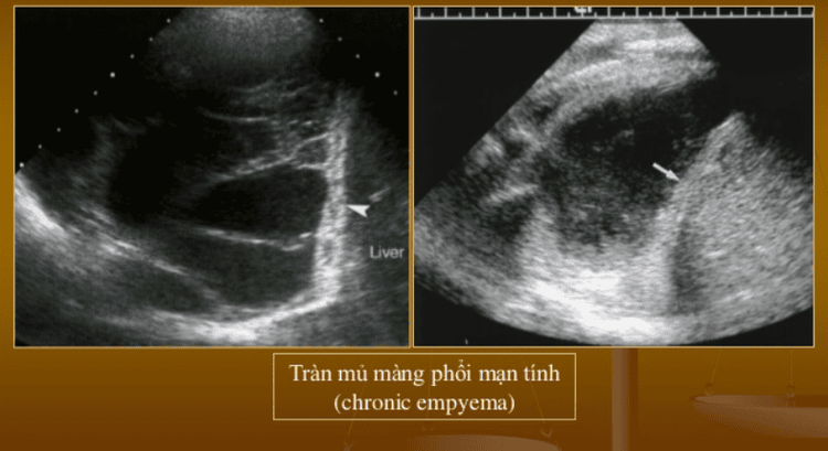 
Siêu âm phổi có giá thành khá rẻ
