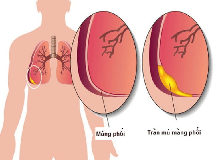 
Viêm mủ màng phổi là hiện tượng mủ có trong khoang màng phổi
