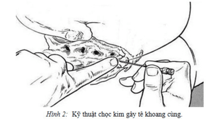 Anesthesia of the sacral cavity