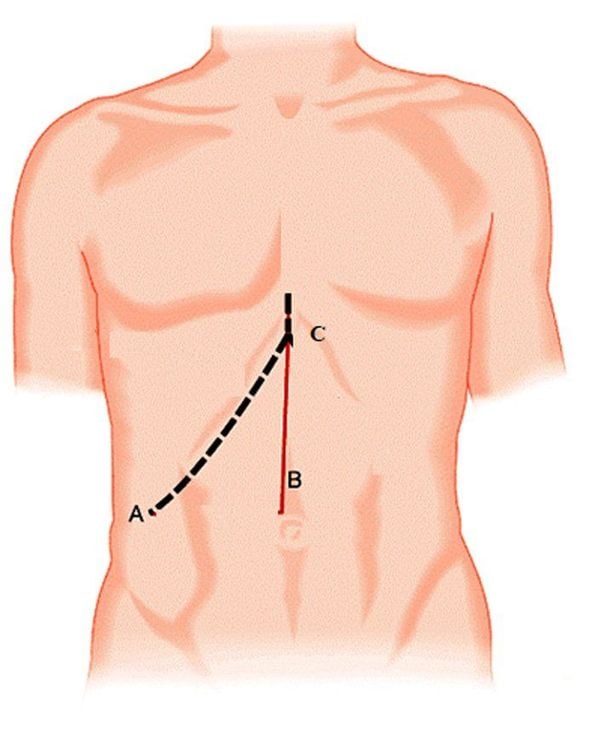 What you need to know about acute cholecystitis caused by gallstones