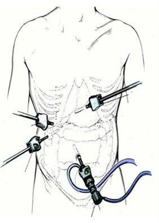 What you need to know about acute cholecystitis caused by gallstones