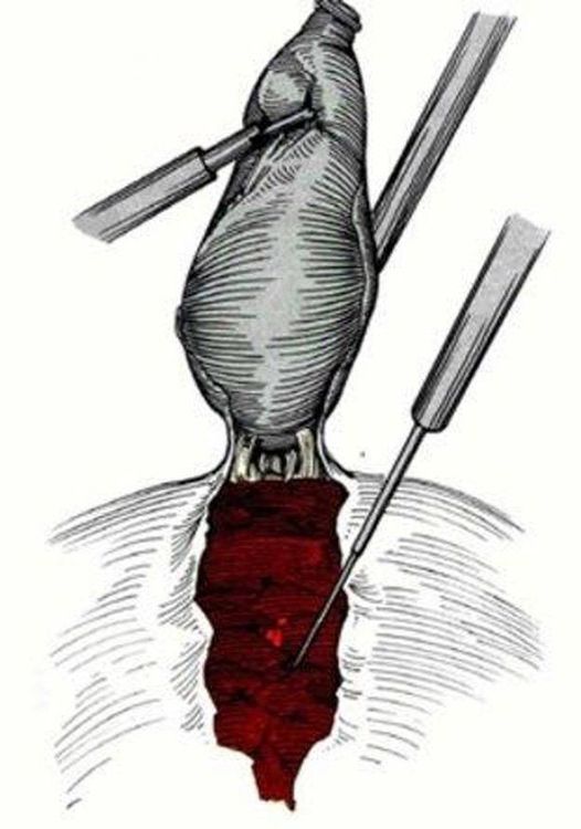 What you need to know about acute cholecystitis caused by gallstones