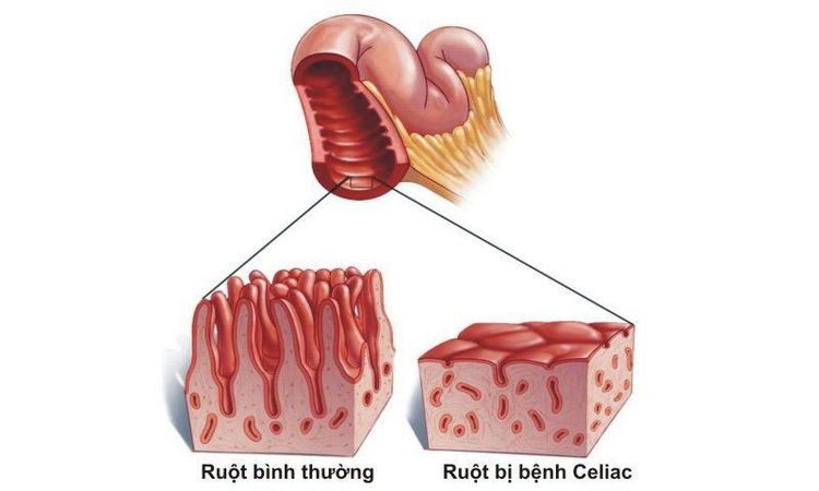 
Caliac khiến người bệnh cảm thấy bị khó chịu khi dung nạp thực phẩm chứa gluten
