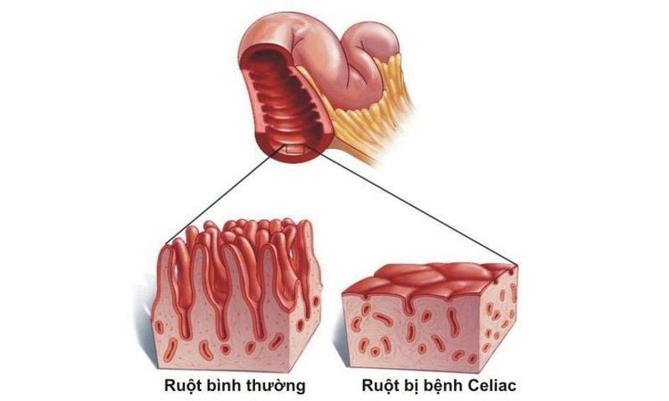 
Bệnh Celiac (Không dung nạp Gluten)
