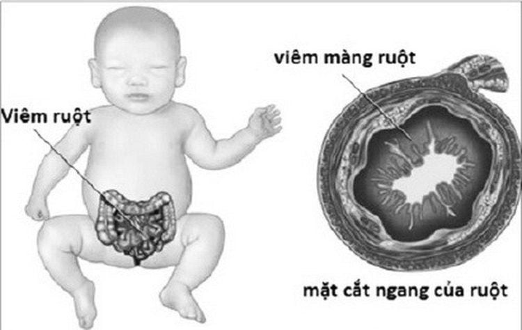 
Viêm màng ruột - viêm ruột
