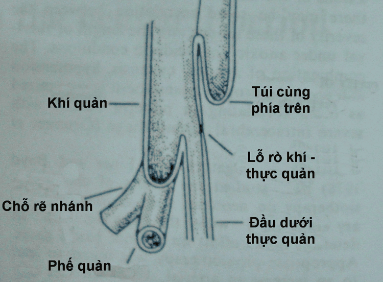 
Vị trí dò khí phế quản - thực quản
