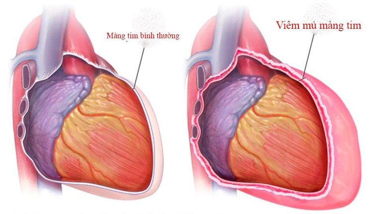 
Hình ảnh viêm mủ màng tim
