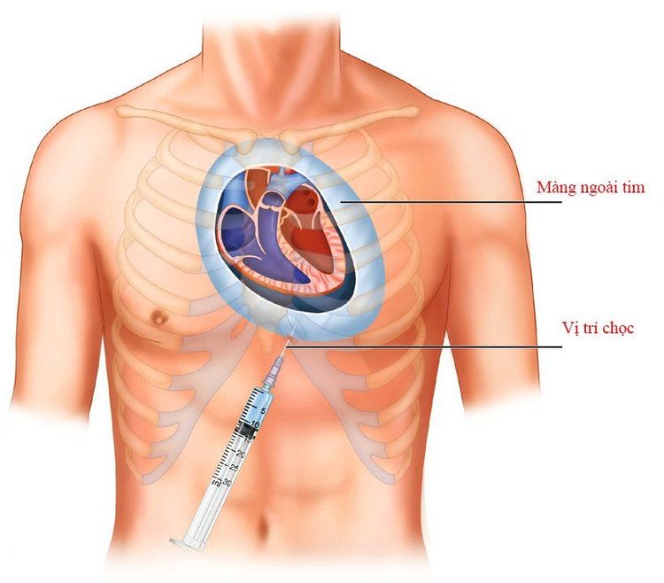 
Chọc kim dẫn lưu màng ngoài tim
