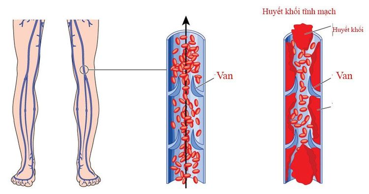 
Bệnh thuyên tắc huyết khối tĩnh mạch
