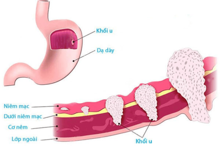 
Các giai đoạn ung thư dạ dày
