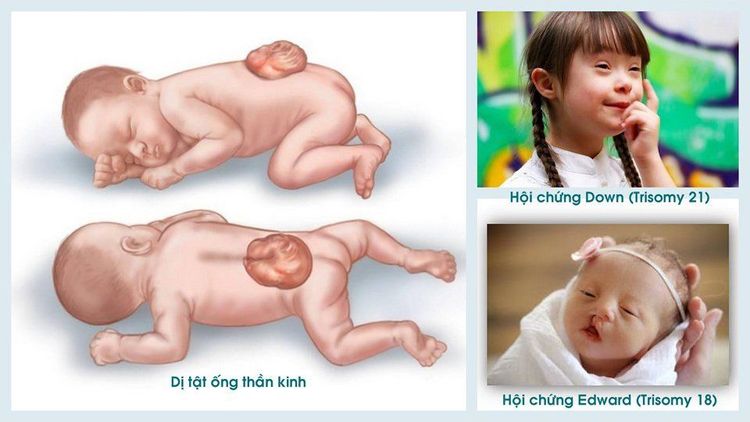 
Mắc bệnh đái tháo đường thai kỳ có thể dấn đến dị tật thai nhi
