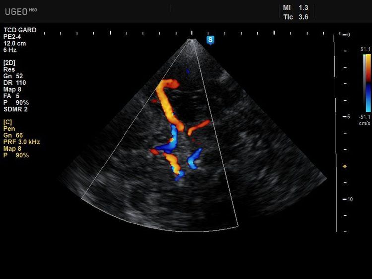 
Siêu âm Doppler xuyên sọ được áp dụng rộng rãi để phát hiện đột quỵ não
