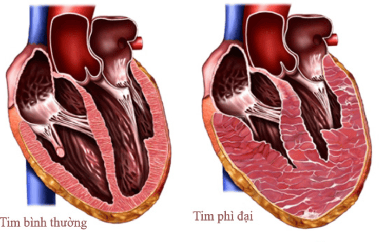 
Bệnh phì đại thất trái có thể gây suy tim
