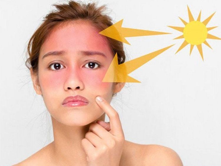 
Bệnh nhân mắc Lupus ban đỏ thường nhạy cảm với ánh nắng mặt trời
