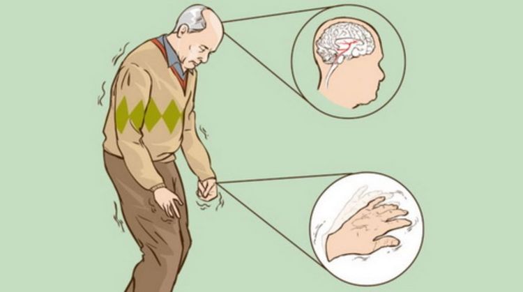 
Hội chứng Parkinson với biểu hiện vận động chậm
