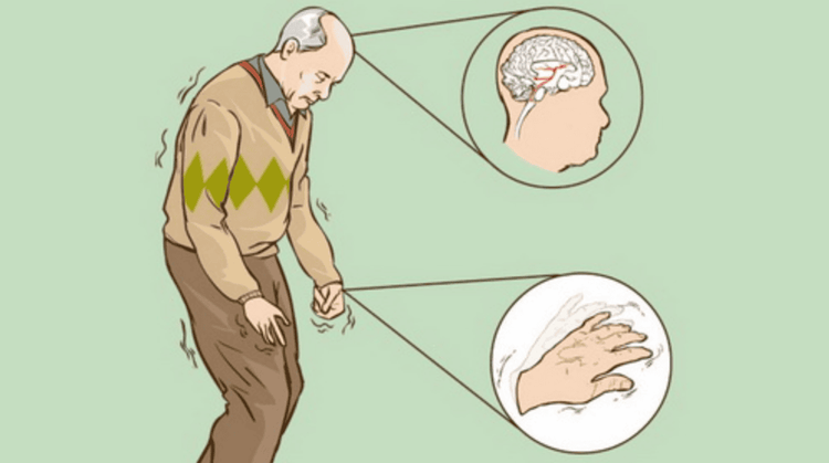 
Bệnh nhân bị bệnh Parkinson có thể là nguyên nhân làm rỗng dạ dày chậm
