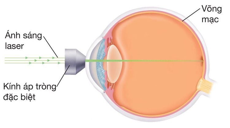 
Phương pháp điều trị bệnh bong võng mạc bằng laser
