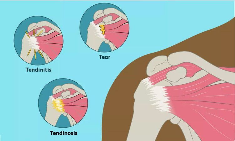 
Ba loại tổn thương gân hay gặp: Viêm gân, thoái hoá gân, rách gân.
