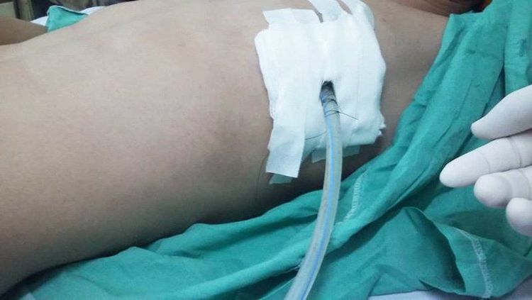 Đầu ống dẫn lưu bằng thuốc đối quang qua hình ảnh của chụp số hóa xóa nền cần được kiểm tra vị trí