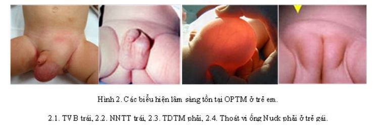 
Thoát vị bẹn bẩm sinh
