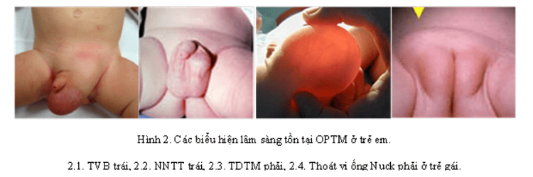 
Thoát vị bẹn bẩm sinh
