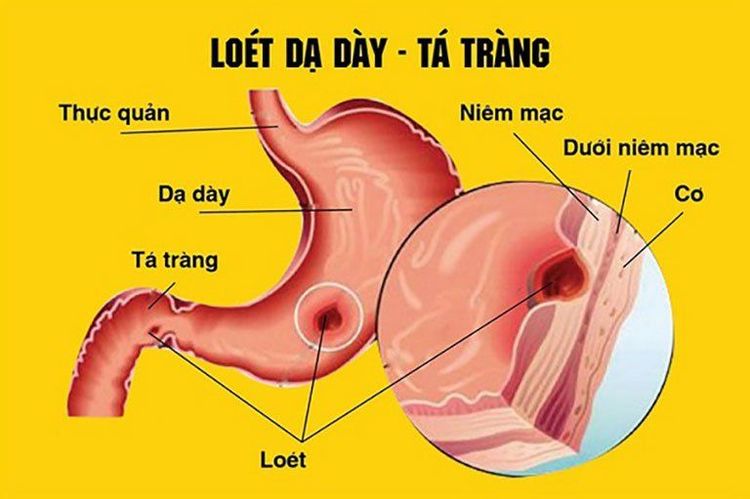 
Thủng loét dạ dày thường xuất hiện một lỗ
