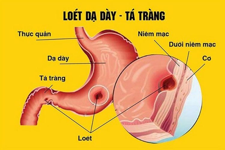 
Loét dạ dày tá tràng là bệnh lý đường tiêu hóa phổ biến hiện nay
