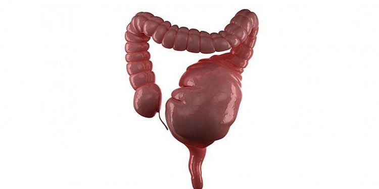 
Megacolon còn gọi là phình đại tràng và cần được phẫu thuật cắt bỏ
