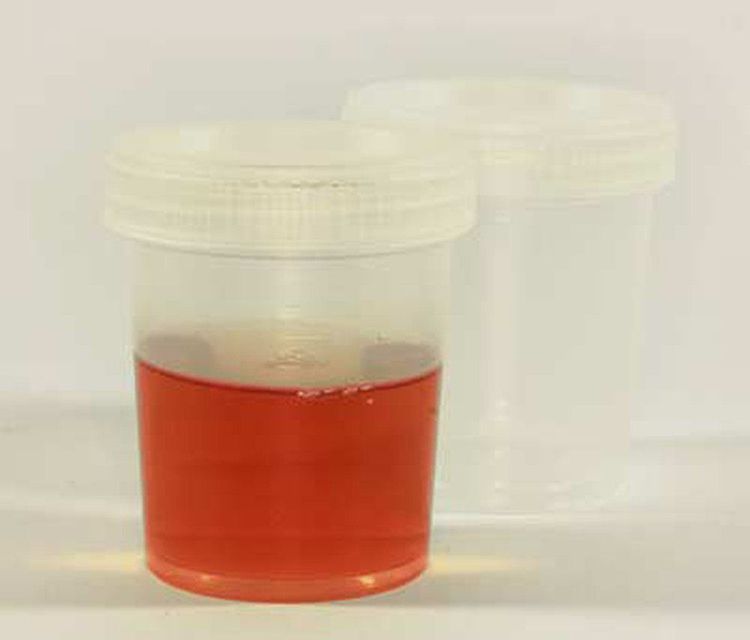 Đái máu có thể là dấu hiệu của bệnh polyp cổ bọng đái