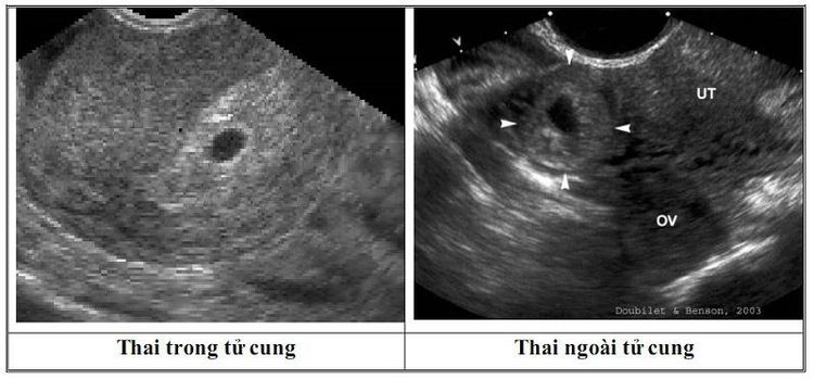 
Thai ngoài tử cung chẩn đoán qua siêu âm
