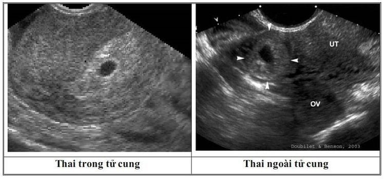 
Viêm ống dẫn trứng có thể gây ra tình trạng mang thai ngoài tử cung
