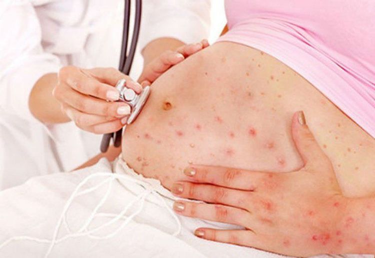 Xét nghiệm thủy đậu trước khi mang thai để tránh nguy cơ cho cả mẹ và bé
