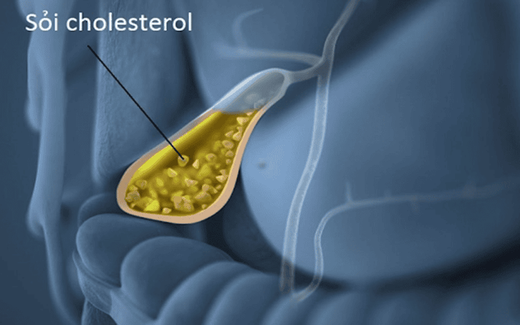 
Sỏi cholesterol là một trong những loại sỏi thường gặp nhất
