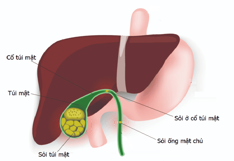 
Sỏi túi mật được hình thành từ nhiều nguyên nhân khác nhau
