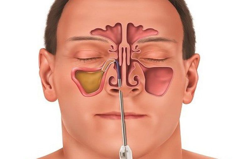 
Endoscopic sinus surgery brings many outstanding advantages
