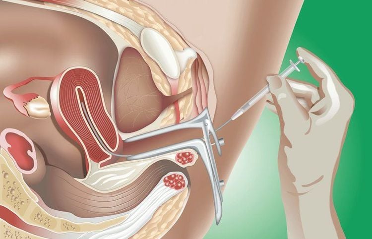 
Bơm tinh trùng vào buồn tử cung thường không gây đau cho người bệnh
