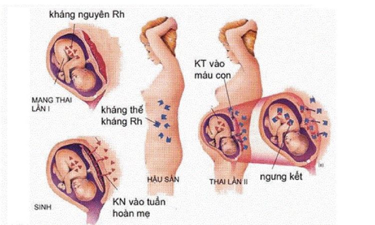 
Bất đồng nhóm máu mẹ con có thể nguy hiểm đến tính mạng thai nhi
