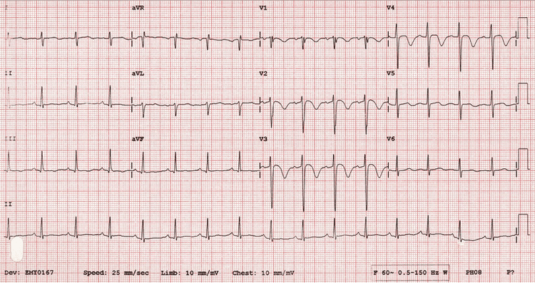 
Các chuyển đạo biểu thị trên kết quả ECG
