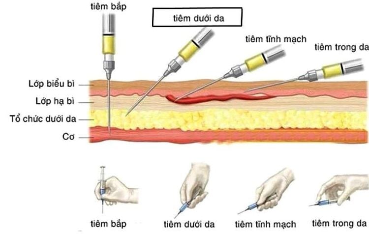 
Một số kỹ thuật tiêm thuốc
