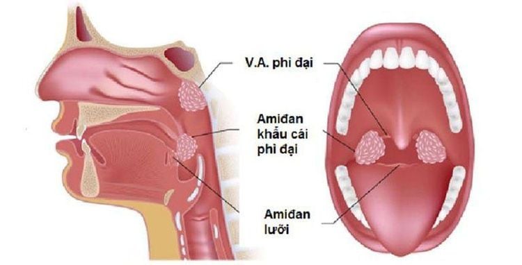 
Some types of tonsillitis
