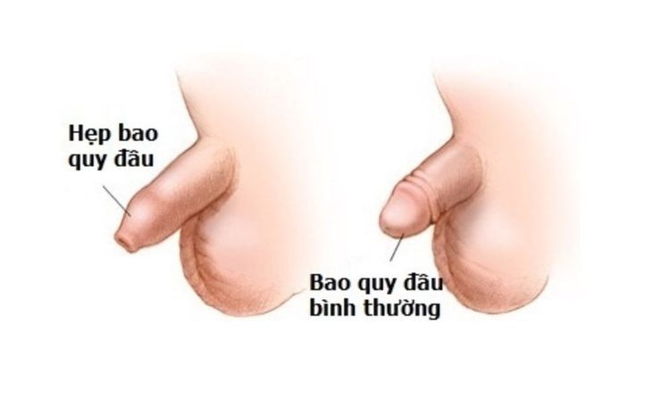 
Hẹp bao quy đầu ở trẻ nhỏ có thể gây nhiễm khuẩn đường tiết niệu
