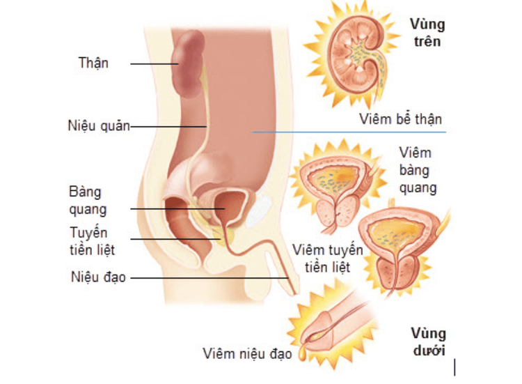 
Những vị trí nhiễm trùng đường tiết niệu thường gặp
