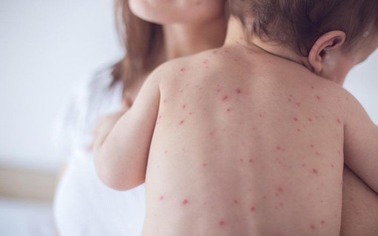 Thủy đậu có thể gây hệ quả nghiêm trọng đối với trẻ em và phụ nữ mang thai