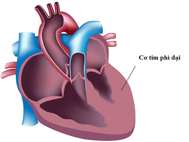 
Phì đại tâm thất bất thường là nguyên nhân chính khiến tim hở van 3 lá 1/4
