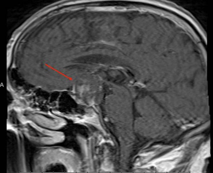 
Ngoài chụp CT, có thể chụp MRi để chẩn đoán máu tụ ngoài màng cứng
