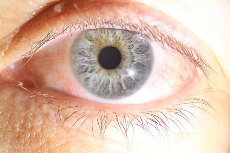 
Khô mắt có thể gặp sau mổ lasik
